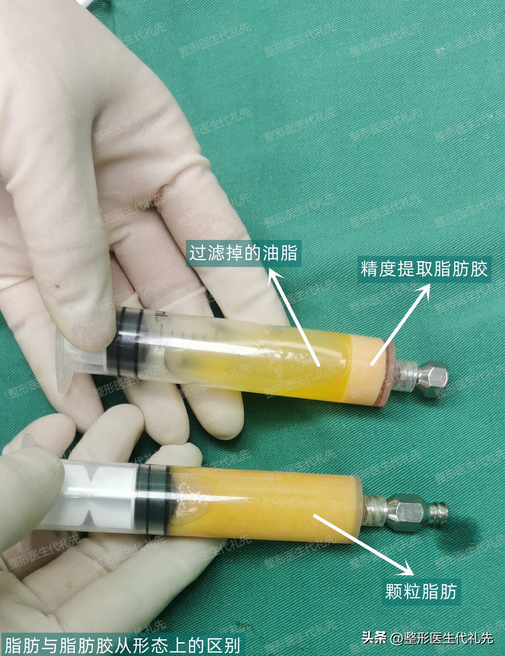 眼窝和法令纹凹陷很深怎么办,二十岁苹果肌饱满法令纹严重