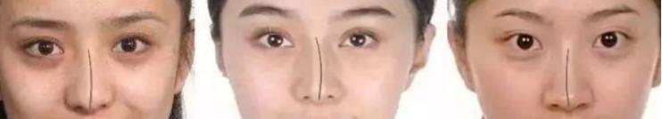 鼻子歪了不通气怎么办,歪鼻矫正改善通气