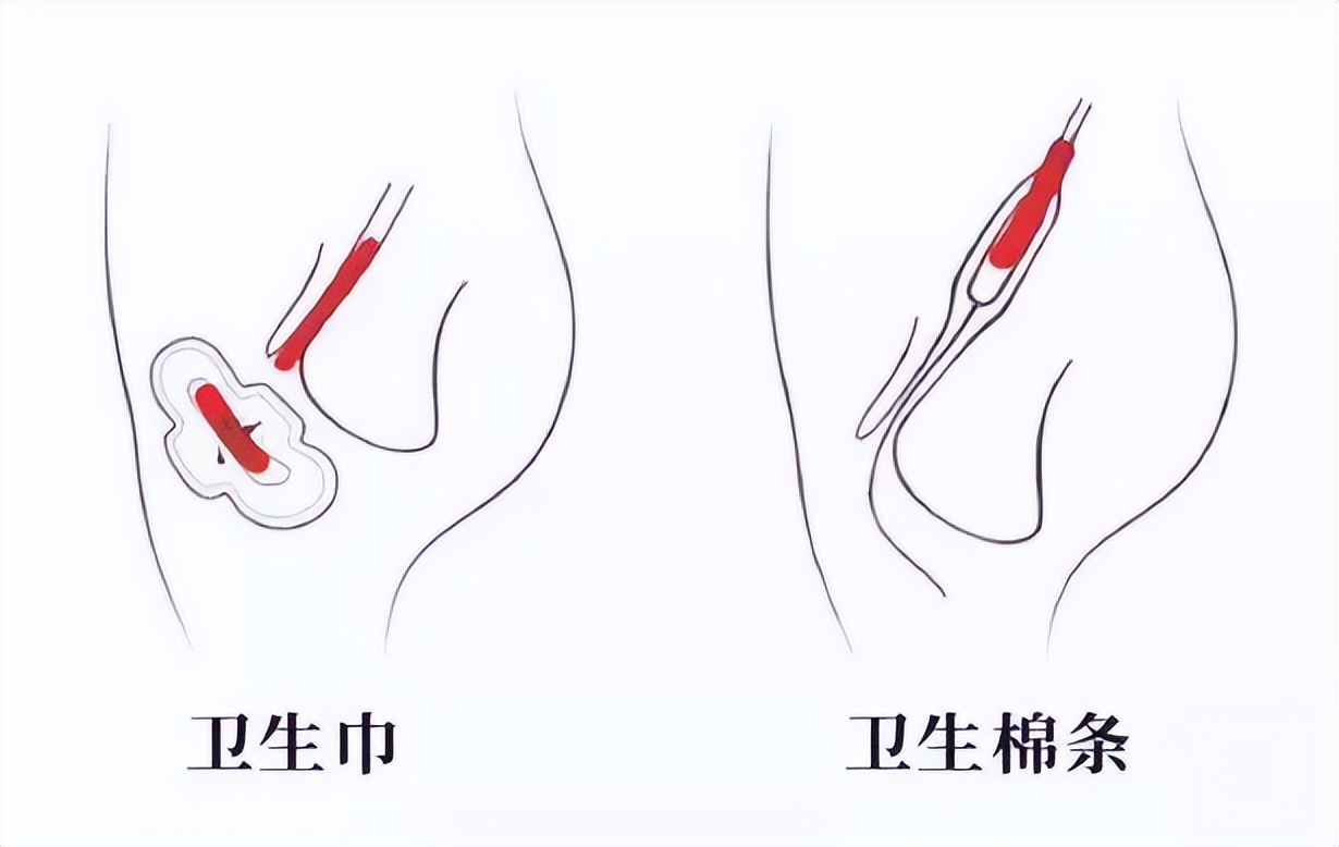 卫生巾里面有虫卵的东西,卫生巾有虫卵用了会怎样