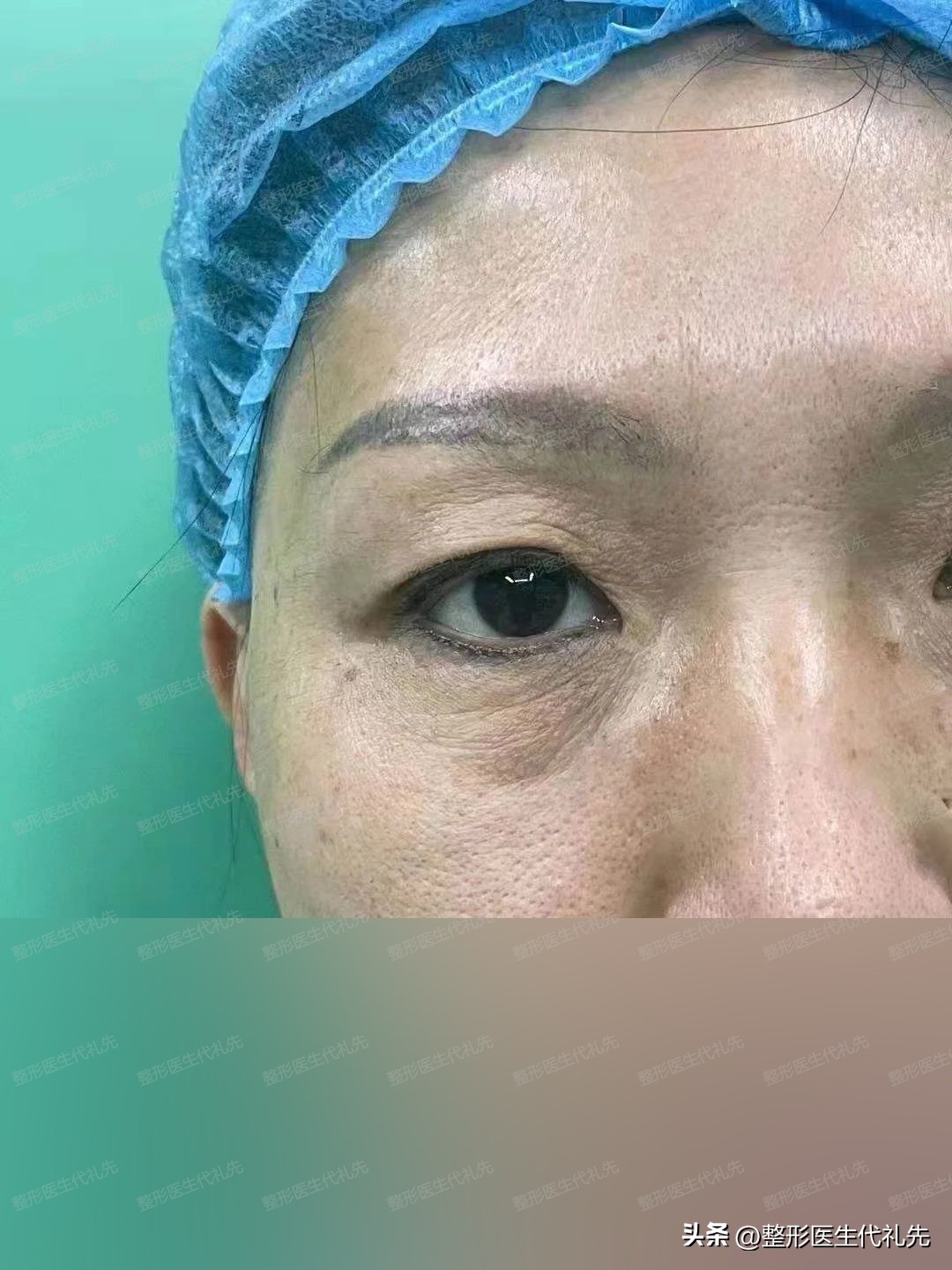 55岁女士做双眼皮能转运吗,北京双眼皮眼袋手术