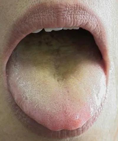 肠胃炎拉大便黑色很湿,肠炎湿热大便粘腻排便费力肚子疼