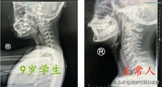 9岁写作业到半夜,孩子写作业时间长脖子疼