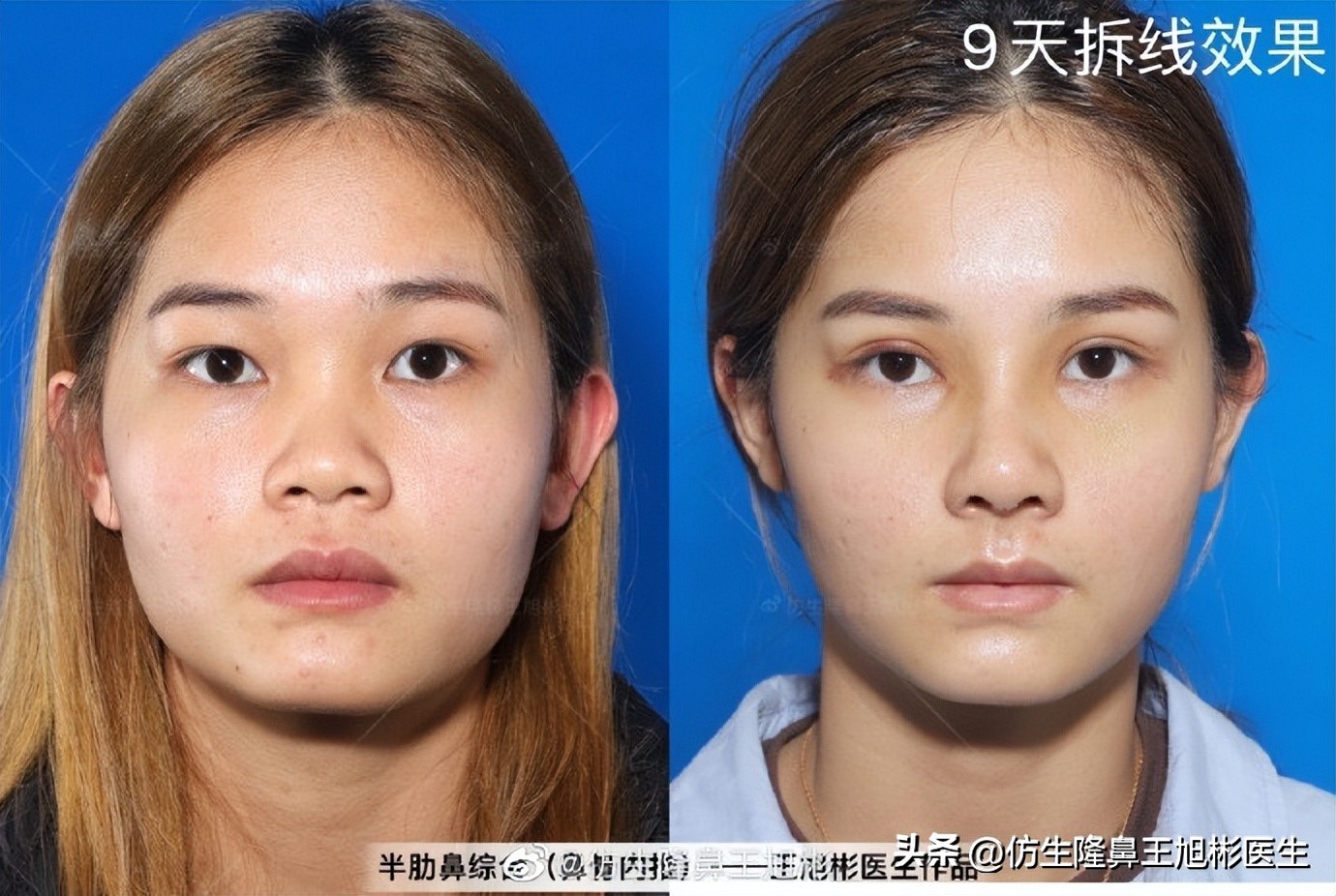 鼻整形后鼻头大,鼻整形后脸小了