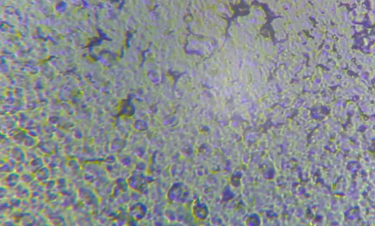 黑头在显微镜上是什么东西,脸上的黑头