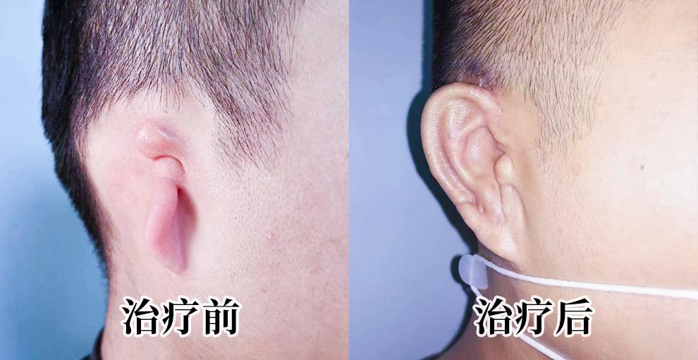 耳朵畸形是什么原因引起的,小孩出生一只耳朵畸形