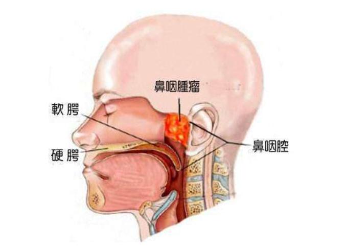 鼻咽癌是怎样放疗的,有什么方法治愈鼻咽癌的