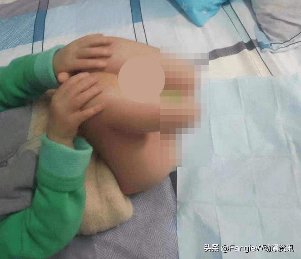 南通被生母虐待的男童永失双脚,南通六岁儿童被虐待后续结果