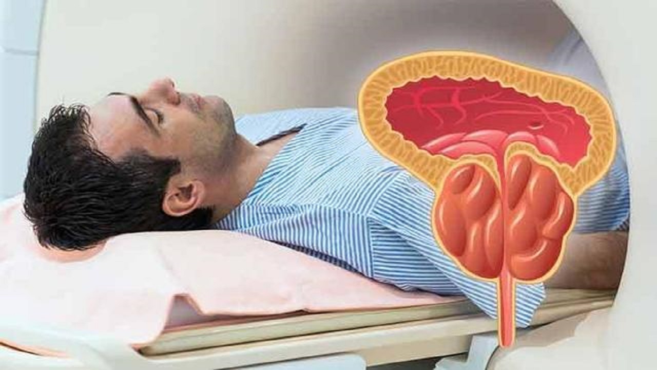 怎样有效预防前列腺癌发生,正确生活方式有助预防前列腺癌