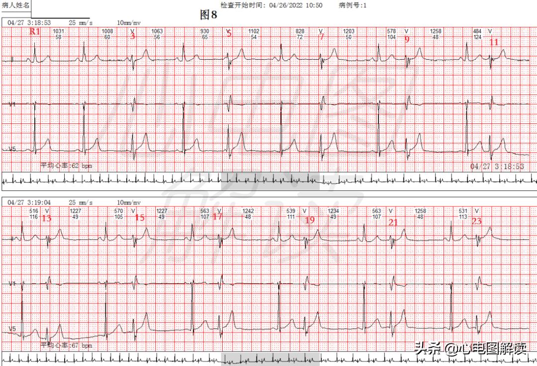 可见室性融合波是什么意思,室性融合波什么意思