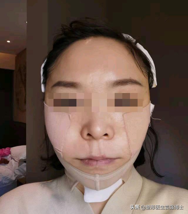 小拉皮20天恢复效果图,拉皮手术后75天复查