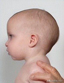 想让孩子有一个漂亮的头型，如何预防和治疗偏头与扁头？