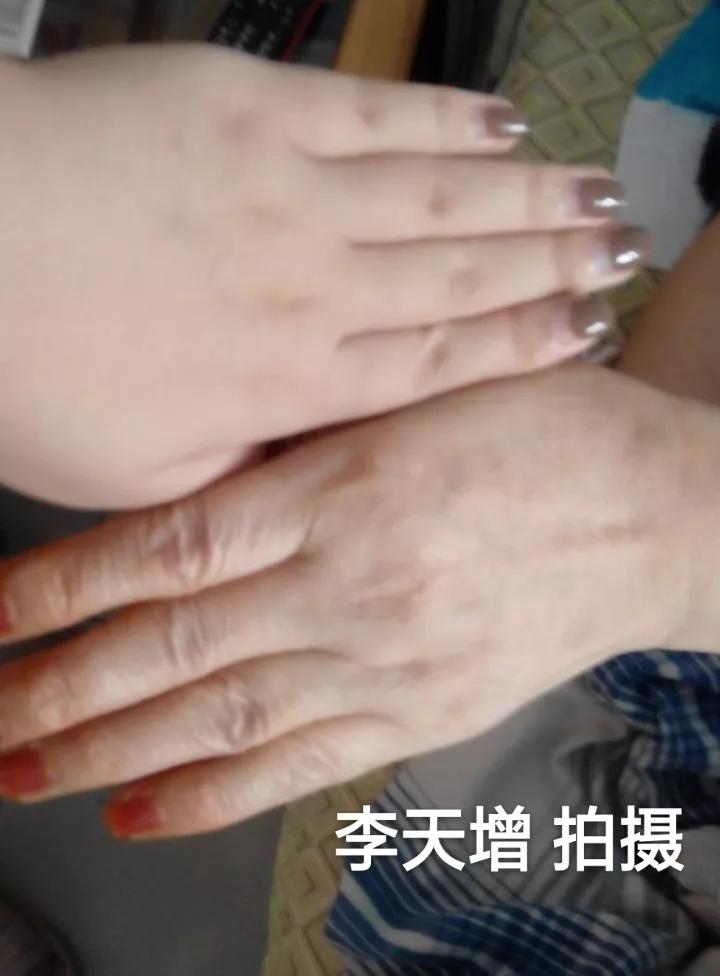 40岁女性手背开始很多皱纹怎么办,手背皮肤松弛皱纹多粗糙是啥原因