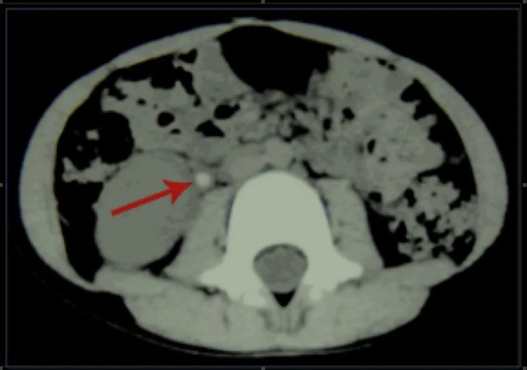 急性肾绞痛是几级,急性肾绞痛吃什么药止痛