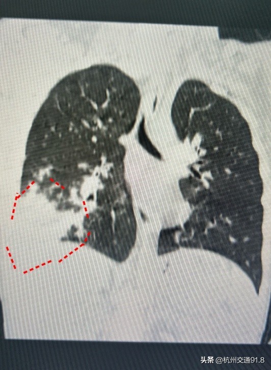 肺炎医院爆满最新消息,杭州支原体肺炎医院爆满