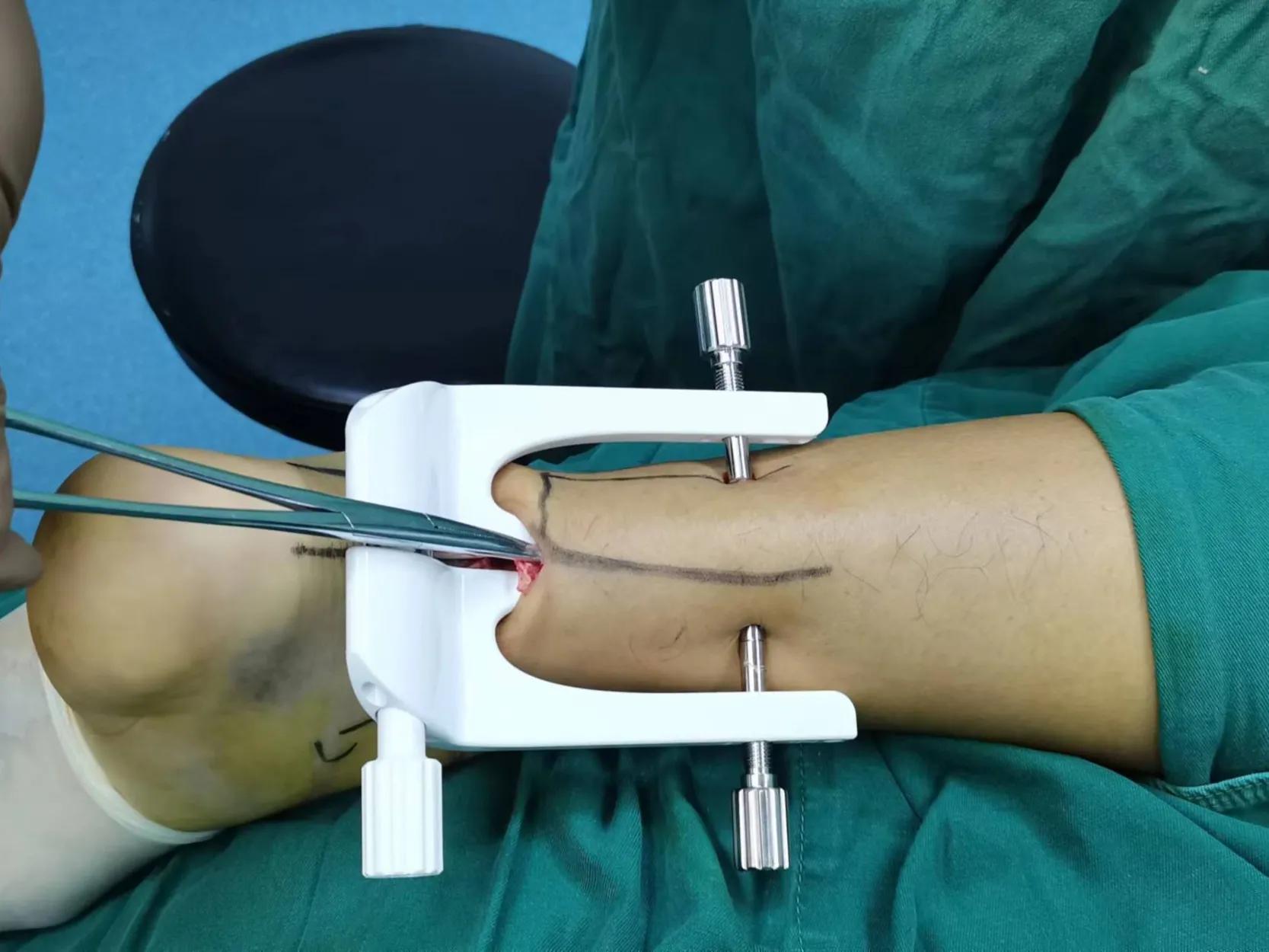 跟腱断裂的微创治疗,跟腱断裂微创手术修复演示图