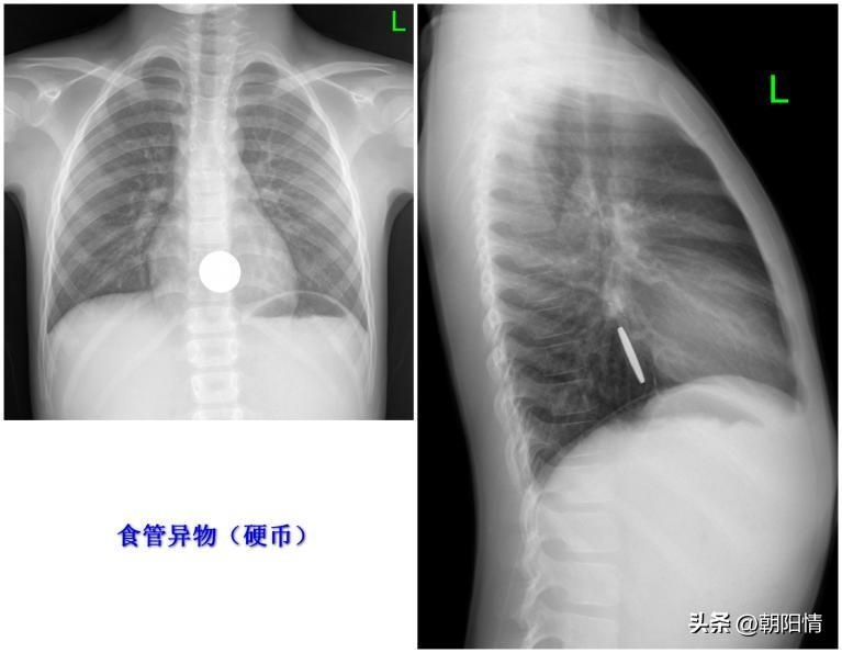 消化道异物中医诊断名称,消化道骨性异物
