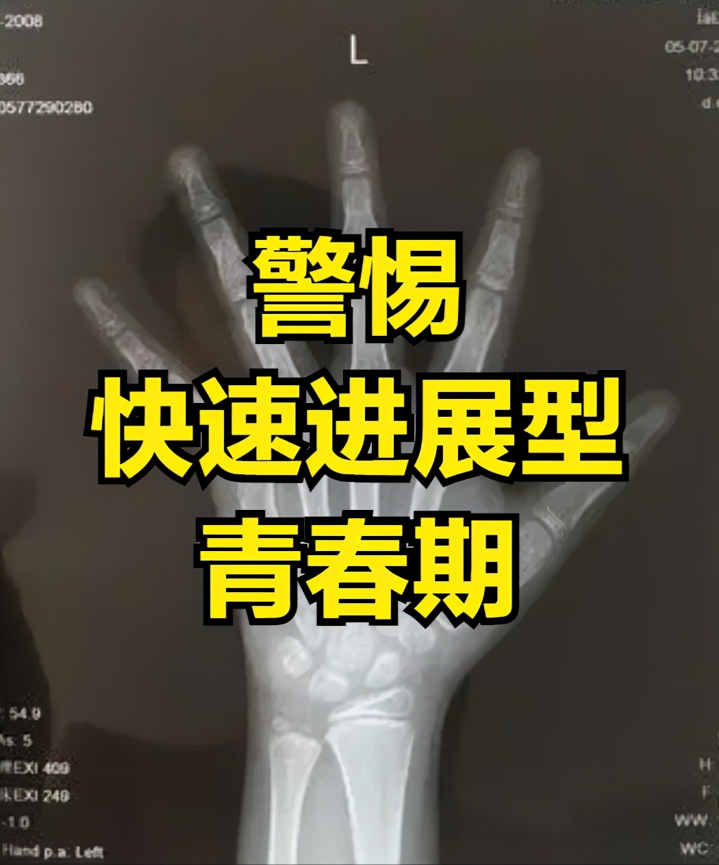 青春期15岁后做什么运动能长更高,青春期猛涨期女孩一年长多少