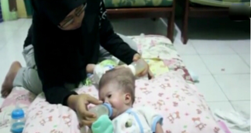 邦克兄弟连体人,连体人怎么进行生育