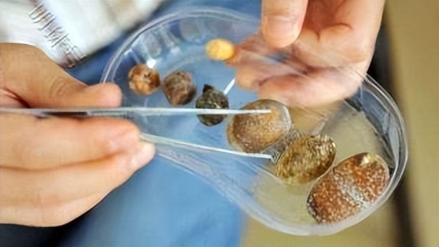 输尿管结石的饮食禁忌事项介绍,胆囊结石微创手术后饮食禁忌