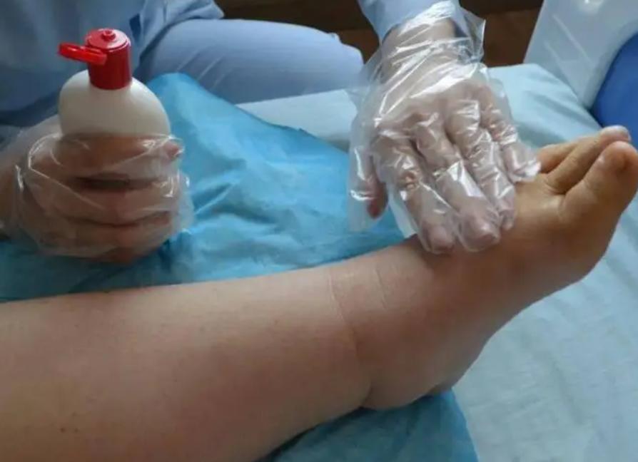 中医治疗心力衰竭效果好吗,中医对心力衰竭是如何辨证