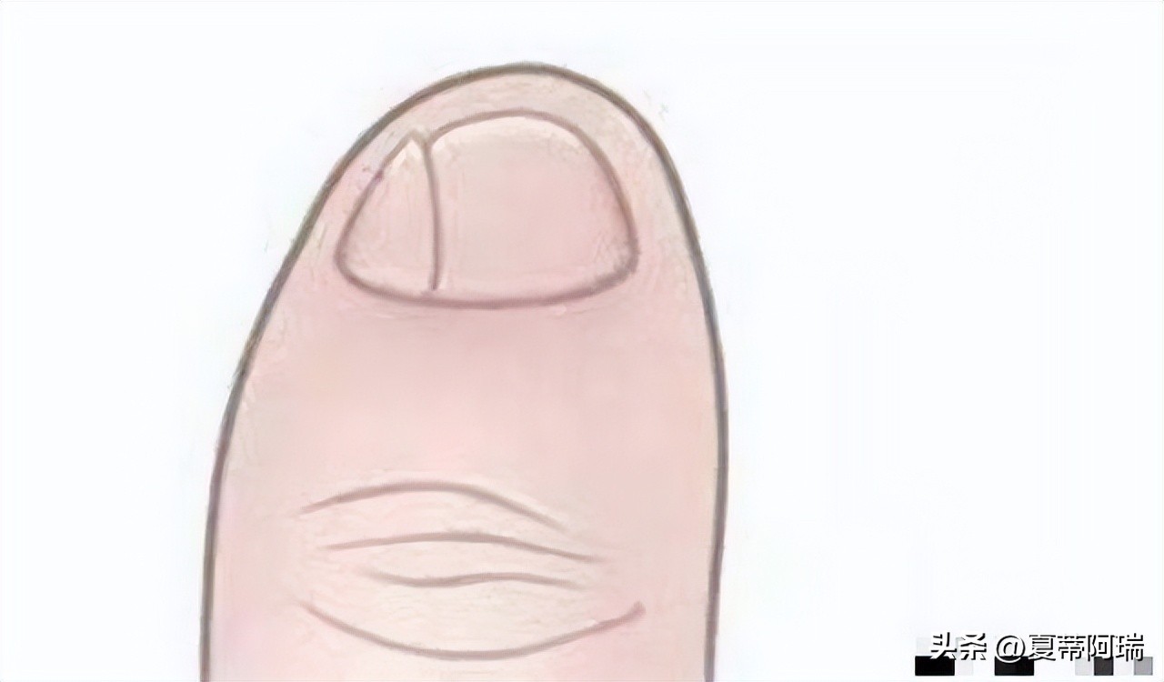 小脚趾甲分叉是汉人还是鲜卑人,为啥小脚趾指甲盖两瓣的是汉人