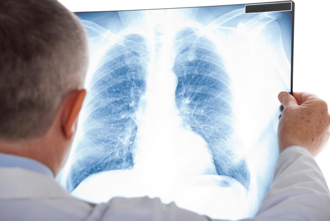 大蒜是肺结节发物吗,大蒜对肺结节有影响吗