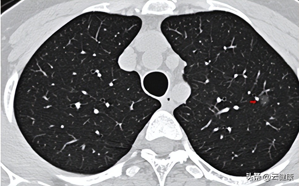 大虾对肺结节有影响吗,吃虾对肺结节有好处吗