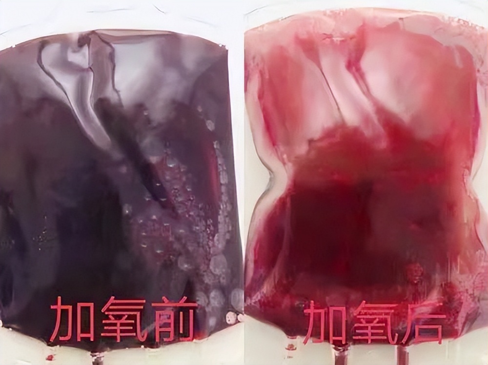 自体血疗法是医疗手段吗,自体血疗法