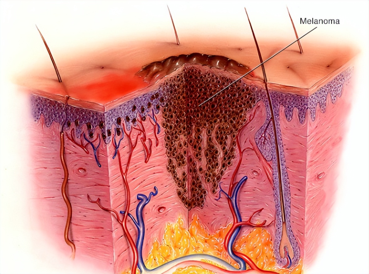 【肿瘤科普】关于黑色素瘤，你需要熟悉的诊疗知识