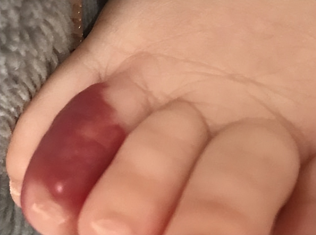 婴儿草莓状血管瘤可以敷眼药水吗,草莓状血管瘤的危害