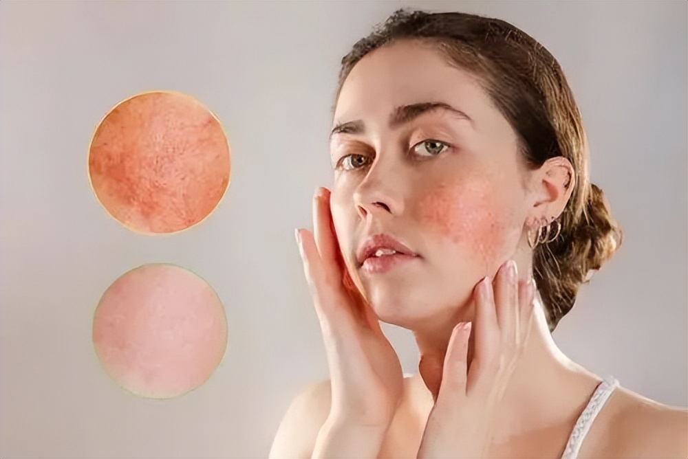 夏季脸过敏发红干怎么快速解决,夏天脸部过敏发红发痒怎么办