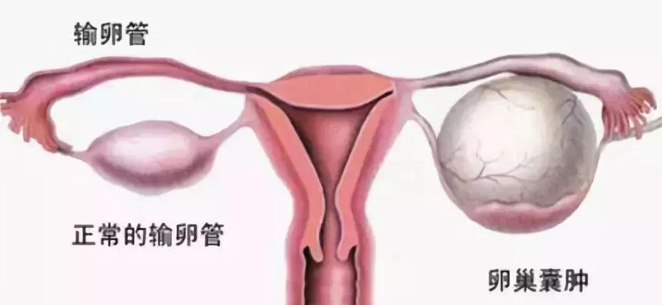卵巢囊肿有什么症状？出现这4个症状，一定要警惕