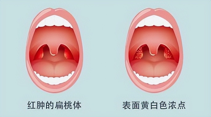 扁桃体炎，不是小病一场！了解它的类型、危害、预防和治疗