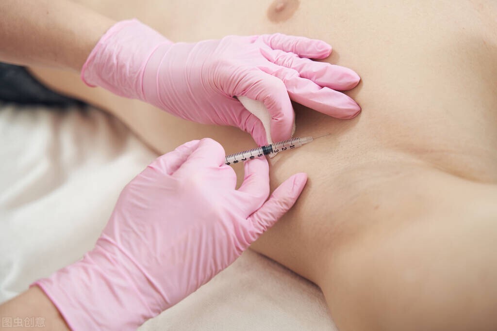 肉毒杆菌揭秘,腋下出汗多打肉毒杆菌有用吗