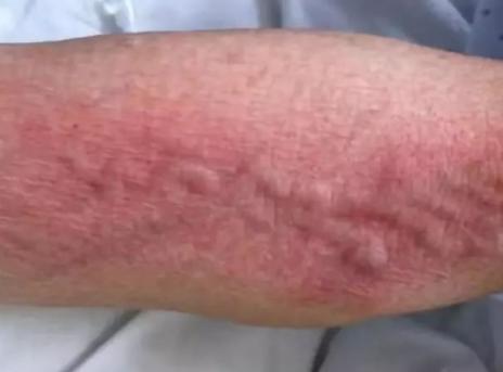 葡萄糖酸钙过敏怎么处理,葡萄糖酸钙口服液加vc治疗过敏吗