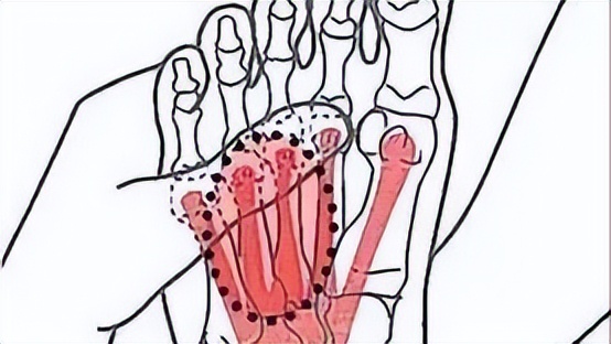 脚底板起茧子走路疼怎么回事,脚底板长茧走路痛咋办