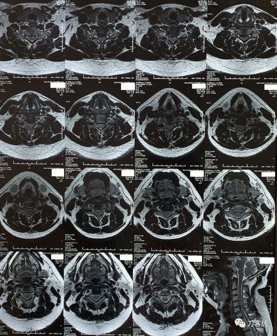 左上肢麻木的病历,颈椎病颈肩胳膊发麻用手术么