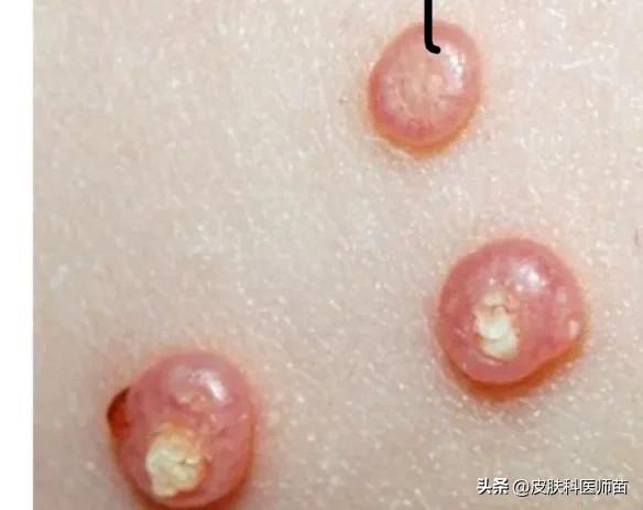 疣和痘痘怎么区分,自己如何鉴别疣