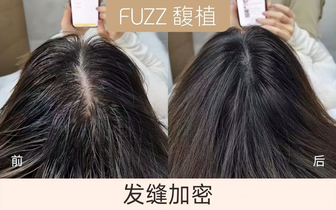 秃顶遗传还能拯救吗,秃顶有什么发型拯救