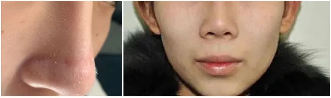 1秒通鼻！10年老鼻炎有救了，终于可以正常呼吸了