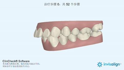 附着在牙齿上面硬硬的东西是什么,牙齿连接处有小疙瘩