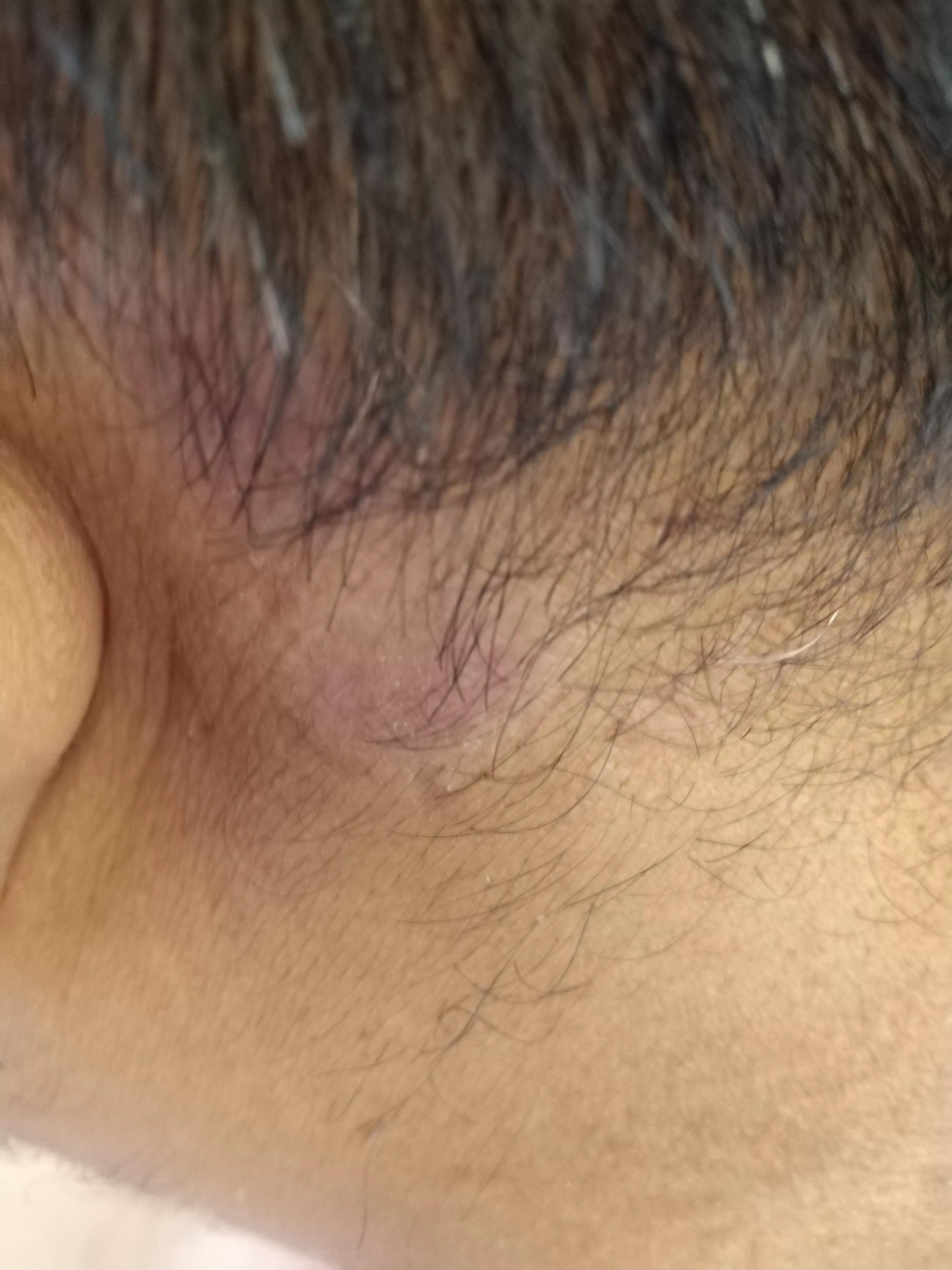 牛皮癣伴随一生是怎么样的体验,对抗牛皮癣一直在坚持