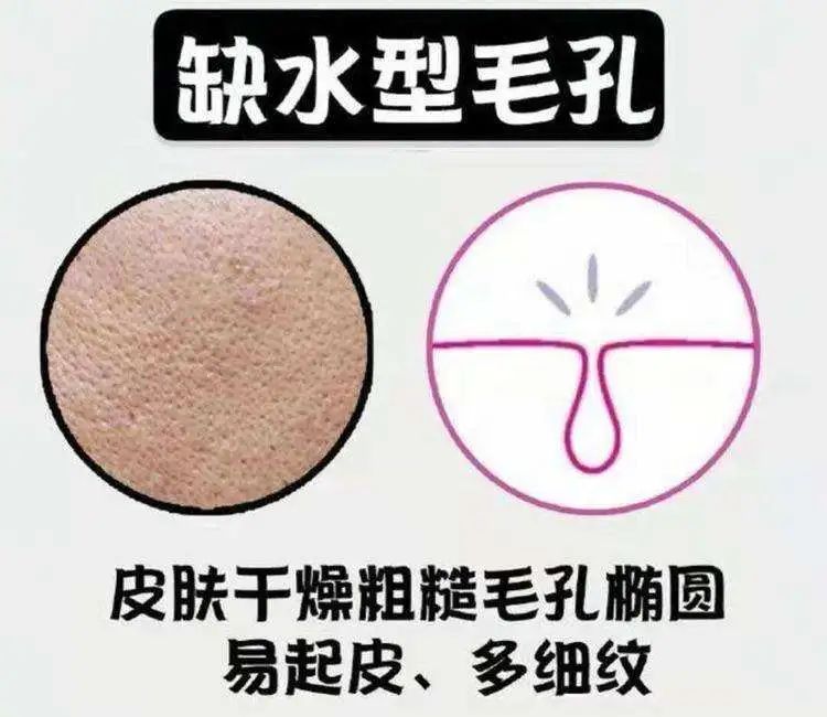 解决毛孔粗大的方法收藏起来,解决毛孔粗大的秘籍你值得拥有