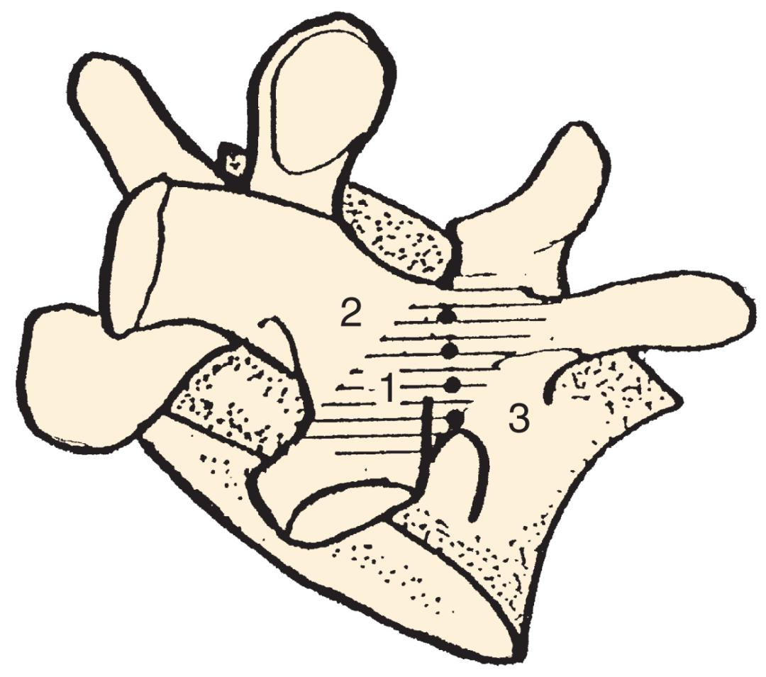 峡部裂和隐性峡部裂有区别吗,单纯峡部裂可以做峡部修复吗