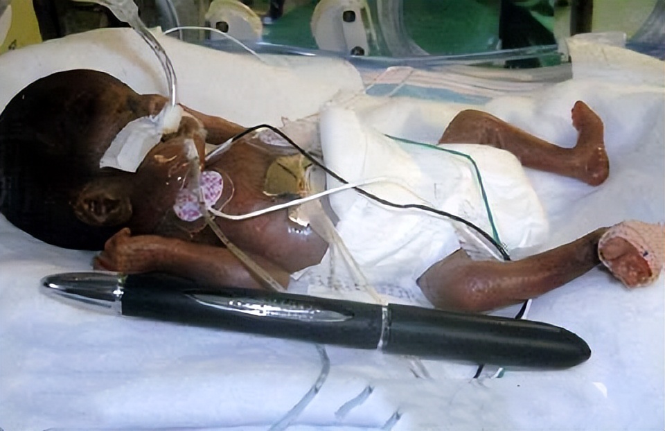 美国真实版拇指姑娘,拇指姑娘出生时图片