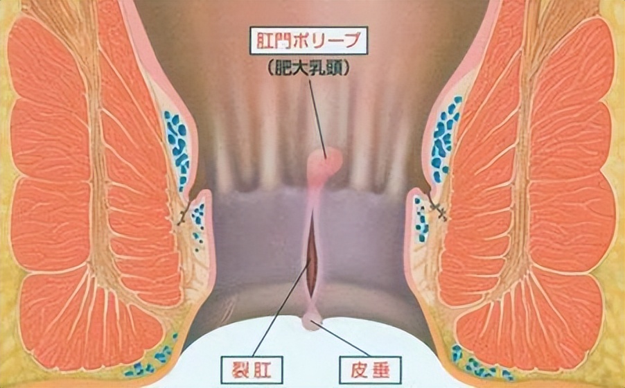 女性易患肛裂的原因是什么,导致肛裂的各种原因
