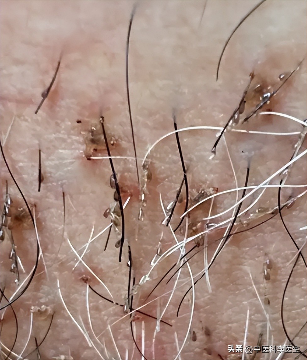 下体瘙痒发现两三只阴虱严重吗,阴部有几十只阴虱