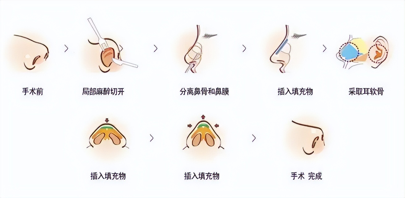 韦敏隆鼻鼻翼缩小,上海韦敏隆鼻案例