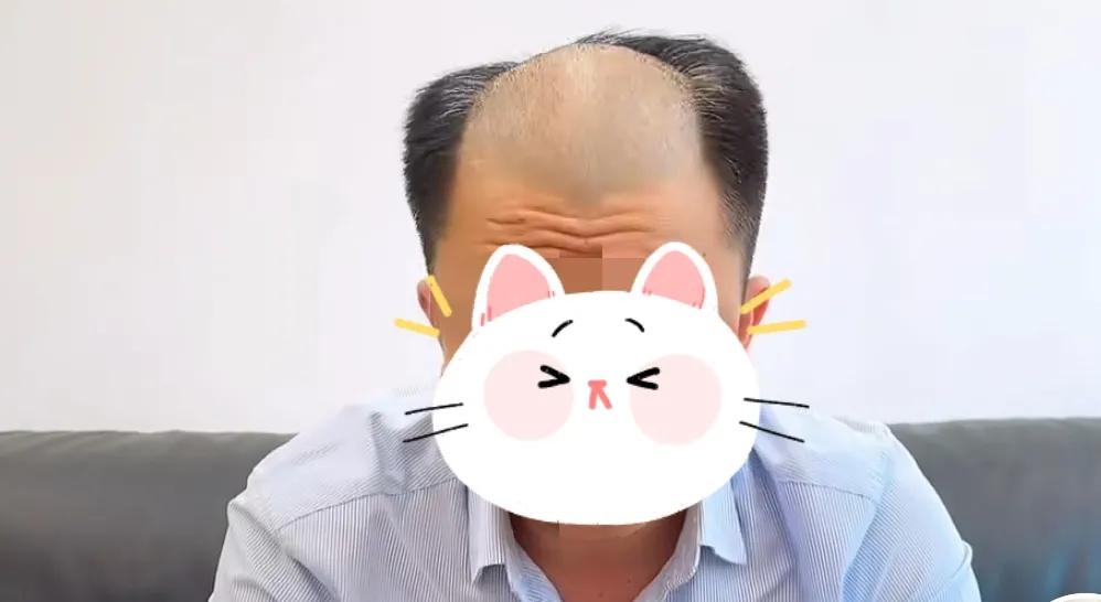 白头发除了可以染色还可以试试假发，亲身经历总结8个热点问题