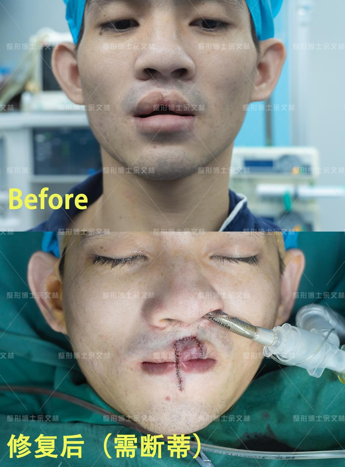 唇裂造成畸形牙矫正视频,唇裂缺陷怎么调理